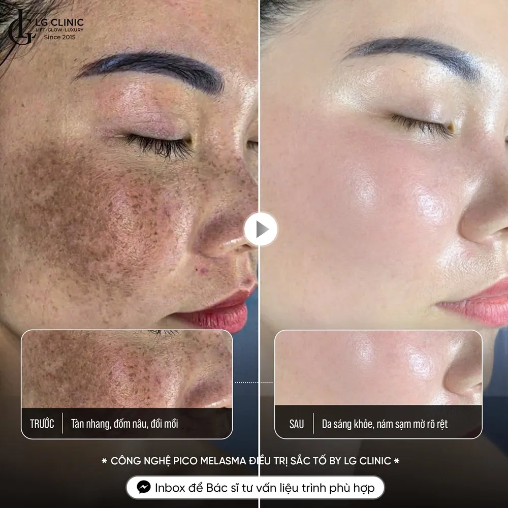 Hình ảnh ba trị nám da
