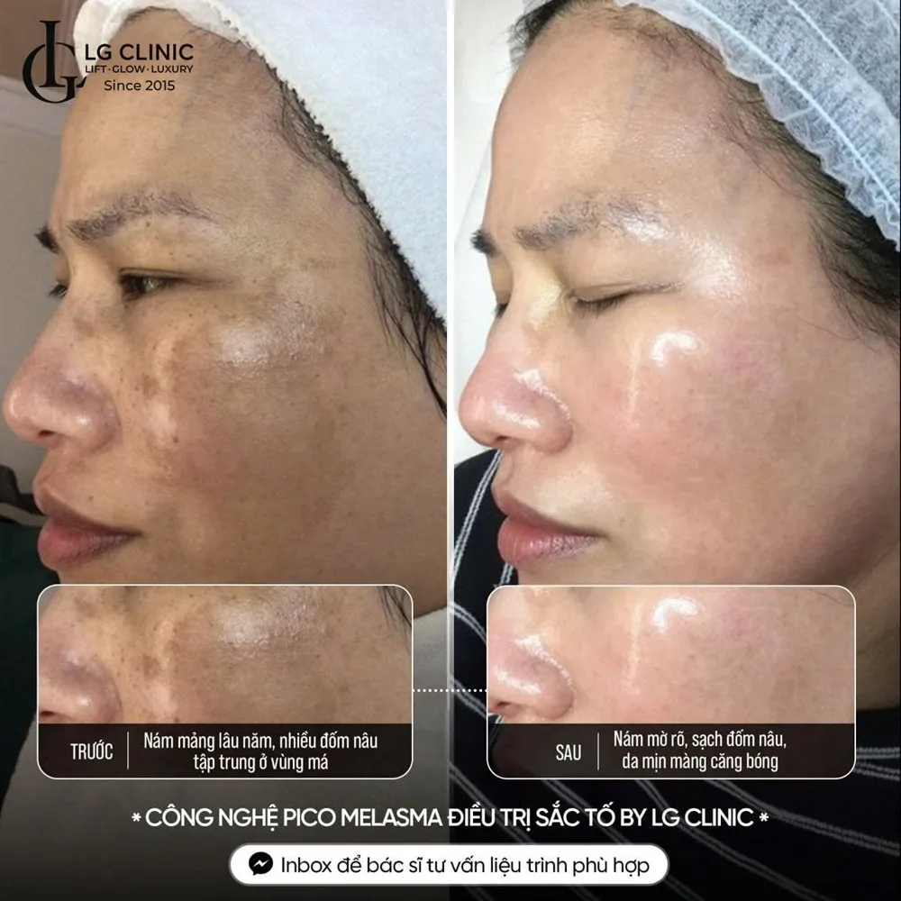 Hình ảnh ba trị nám da