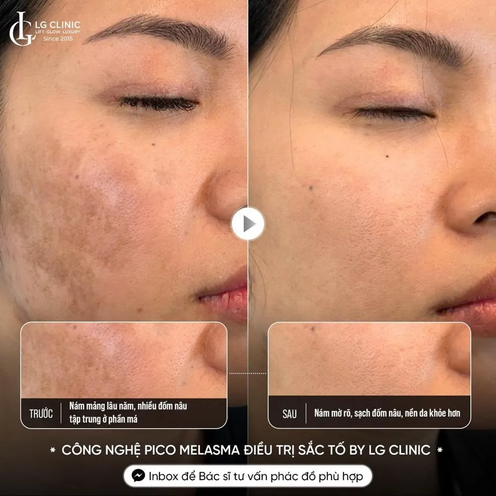 Hình ảnh ba trị nám da