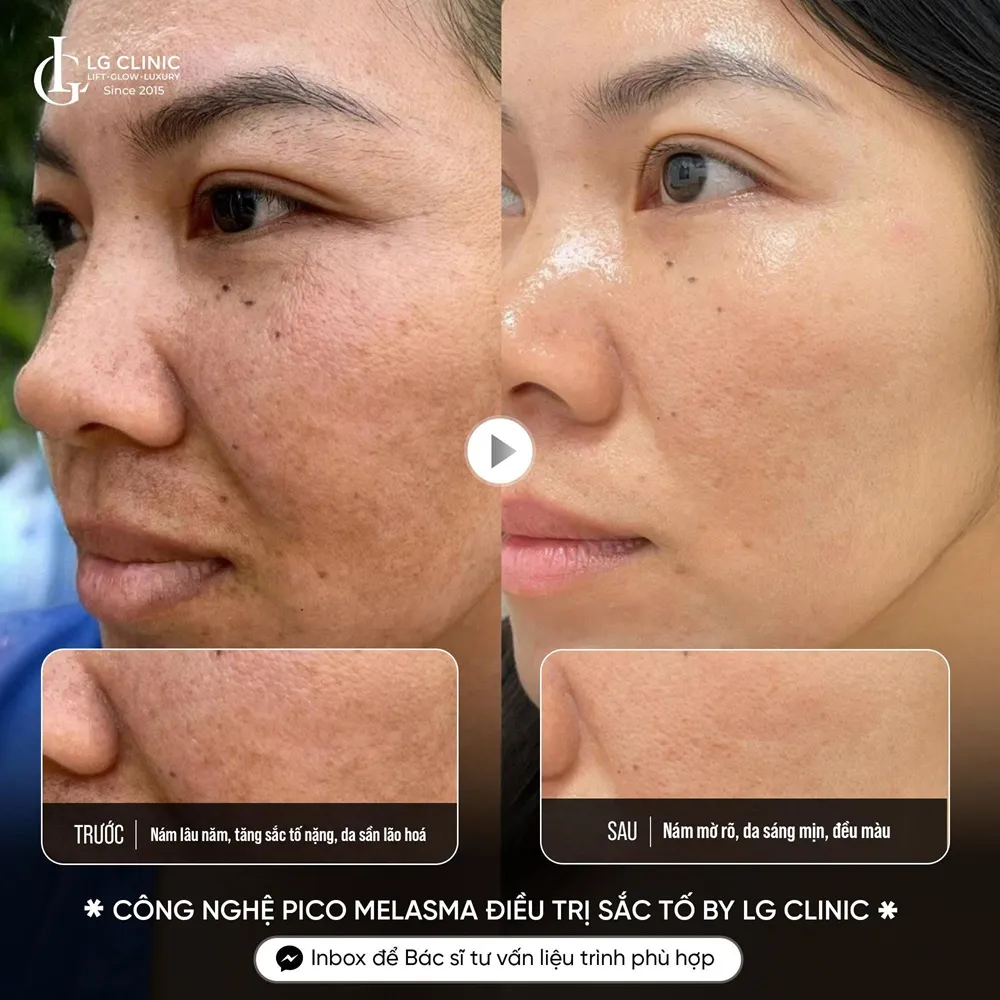 Hình ảnh ba trị nám da