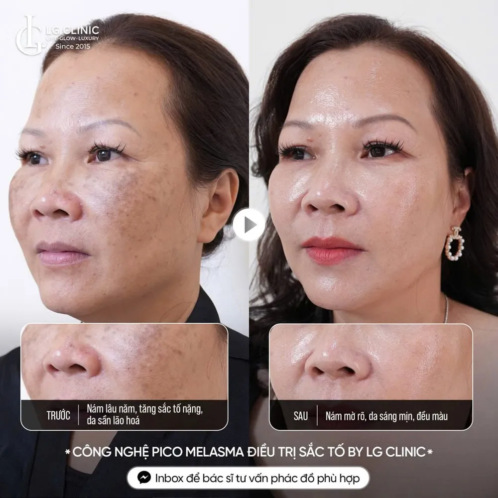 Hình ảnh ba trị nám da
