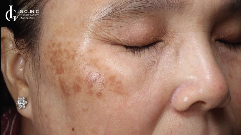 nám có trị tận gốc được không