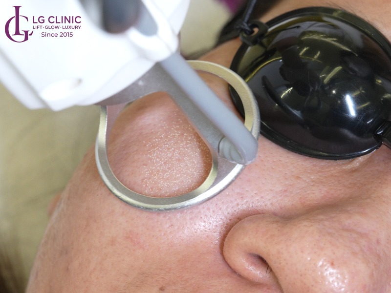 sau laser bao lâu được peel da