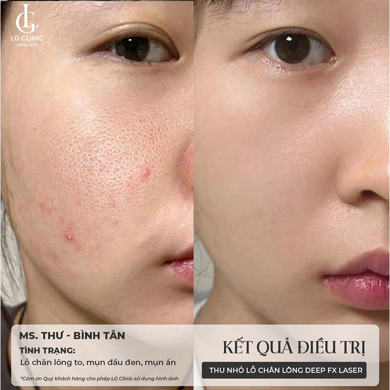 spa thu nhỏ lỗ chân lông quận 3
