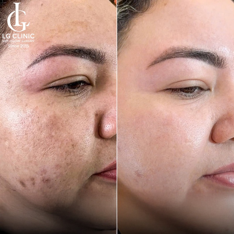 spa trị nám ở bình dương
