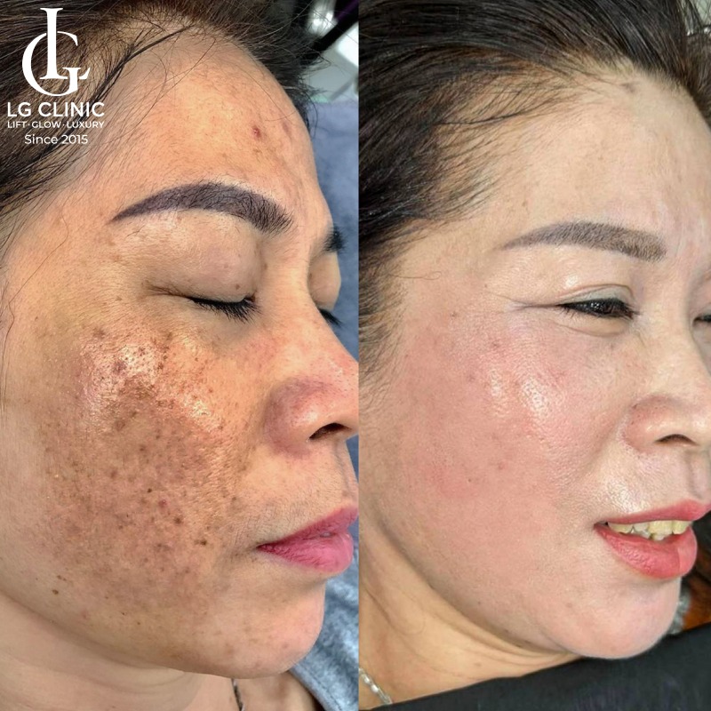 spa trị nám ở bình dương