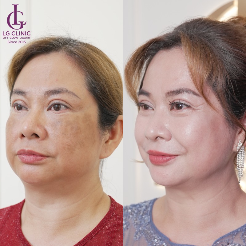 Spa trị nám Vũng Tàu