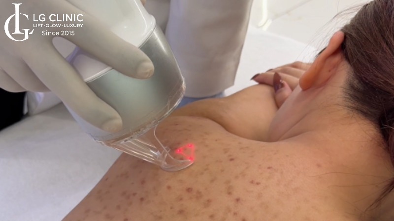 cách trị mụn lưng bằng khổ qua