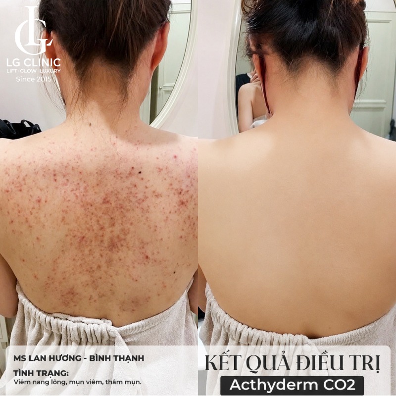 cách trị mụn lưng bằng khổ qua