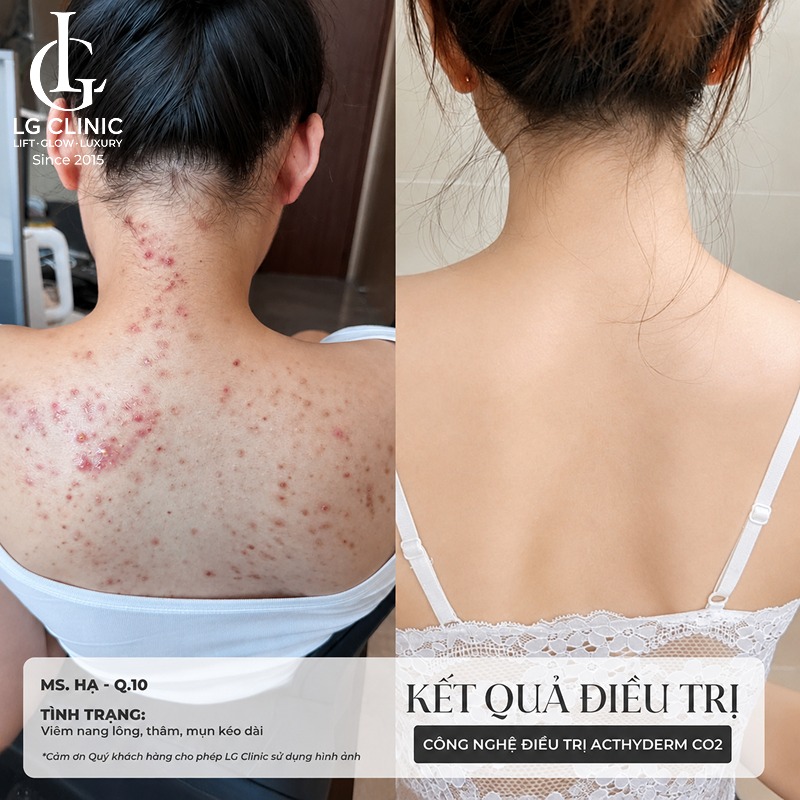 cách trị mụn lưng bằng khổ qua