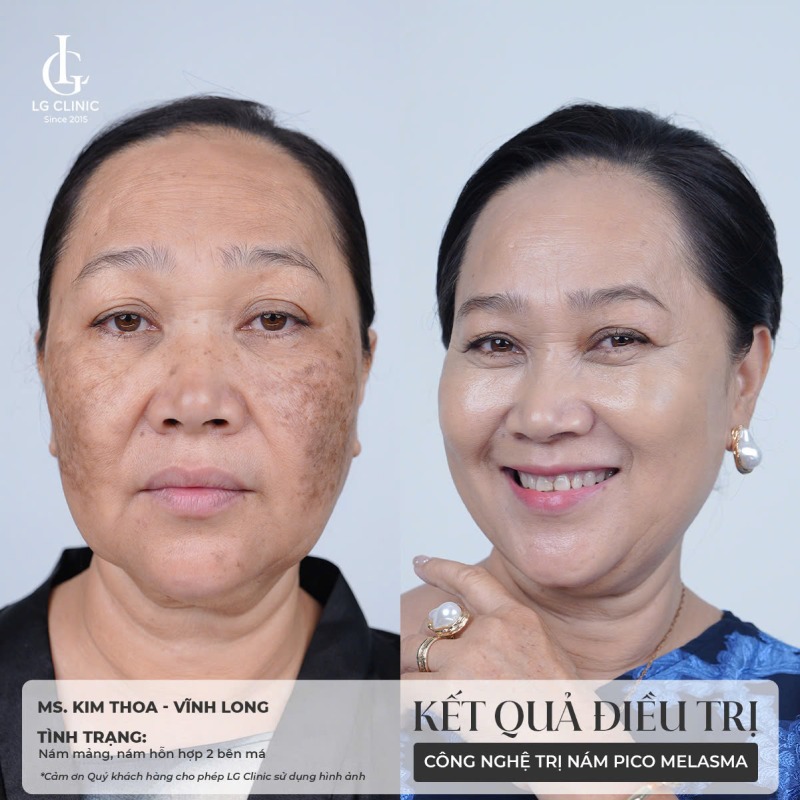 cách trị nám bằng rau ngót