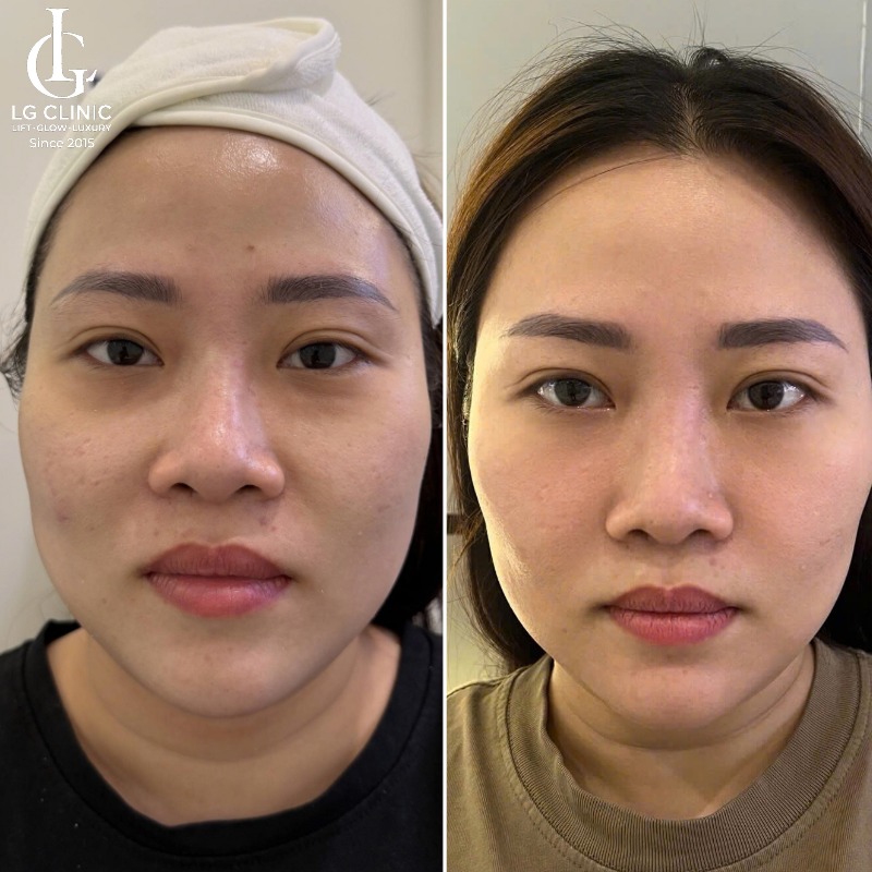 Cám gạo có trị thâm không