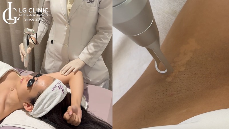 dầu em bé có trị thâm nách không