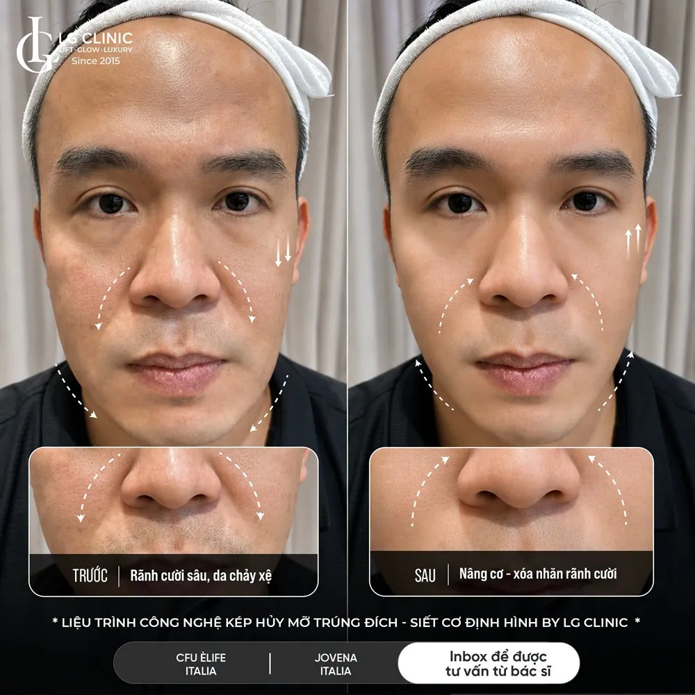 hình ảnh ba rãnh cười