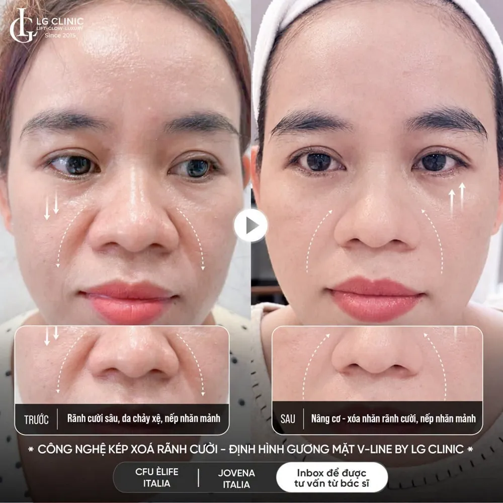 hình ảnh ba rãnh cười