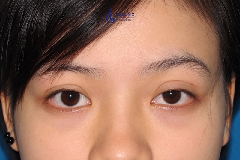 chảy xệ vùng mắt