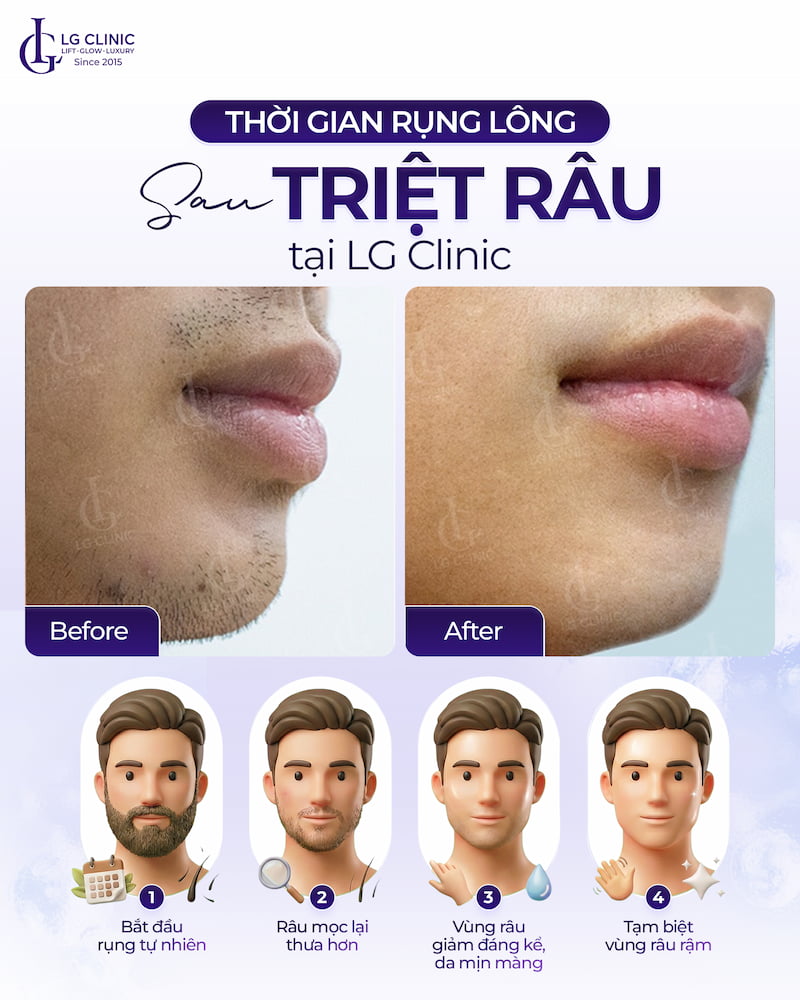 triệt râu nam giới