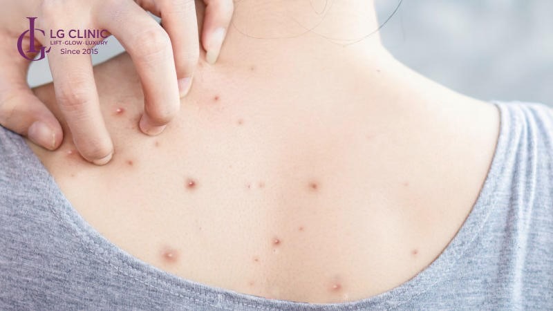 Spa trị mụn lưng Bình Dương