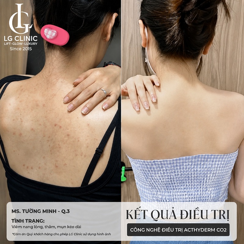 Spa trị mụn lưng Bình Dương