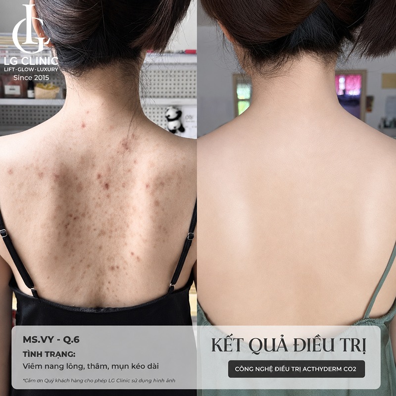 spa trị mụn lưng vũng tàu